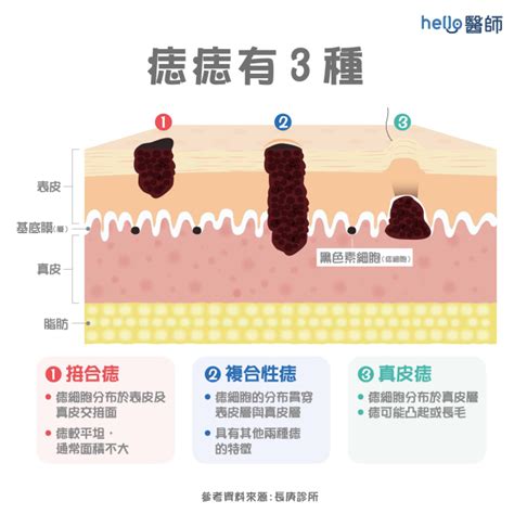 長痣位置|痣形成的原因？痣長毛、痣變多變大是痣病變？5招判。